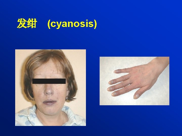 发绀 (cyanosis) 