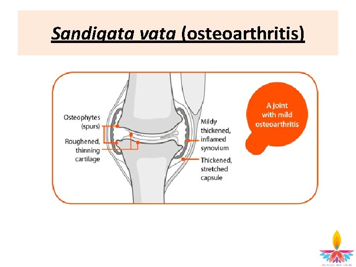 Sandigata vata (osteoarthritis) 