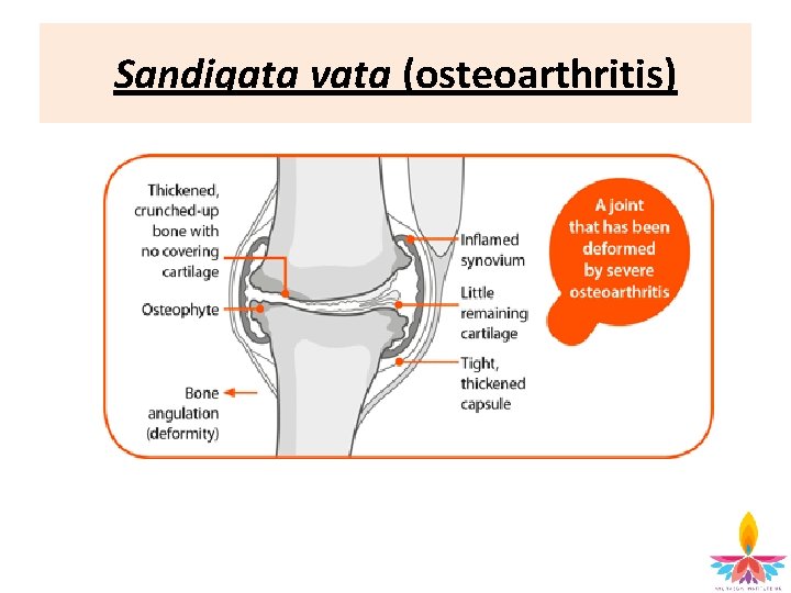 Sandigata vata (osteoarthritis) 