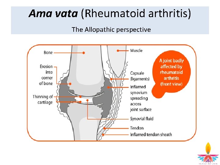 Ama vata (Rheumatoid arthritis) The Allopathic perspective 