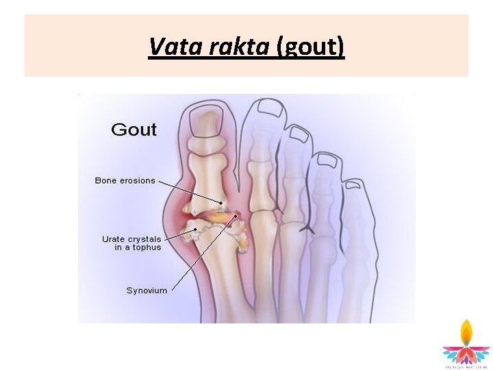 Vata rakta (gout) 