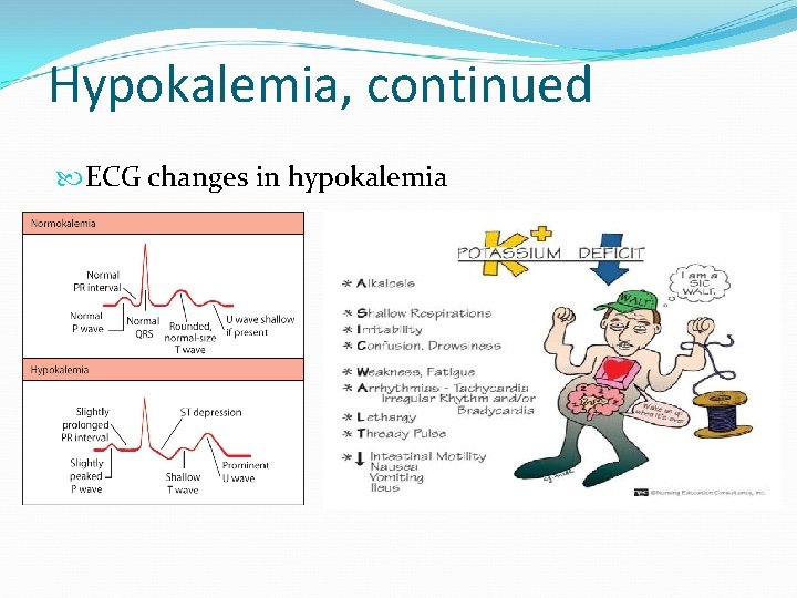 Hypokalemia, continued ECG changes in hypokalemia 