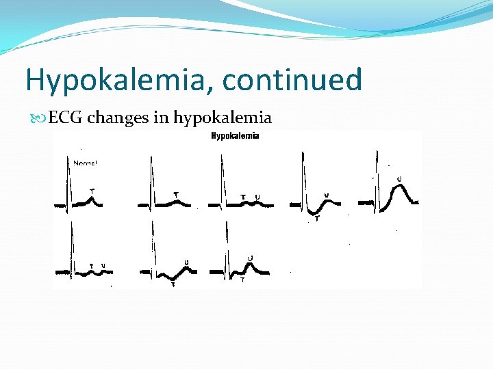 Hypokalemia, continued ECG changes in hypokalemia 