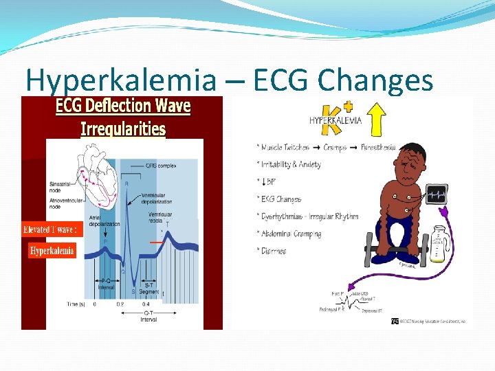 Hyperkalemia – ECG Changes 
