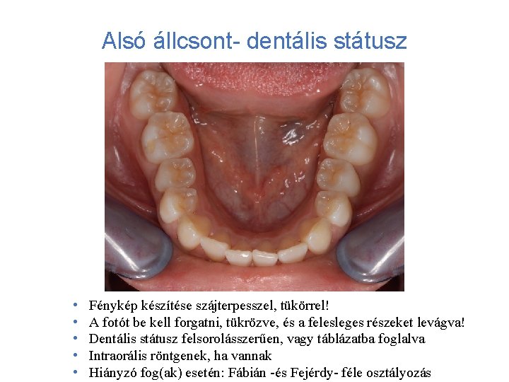 Alsó állcsont- dentális státusz • • • Fénykép készítése szájterpesszel, tükörrel! A fotót be