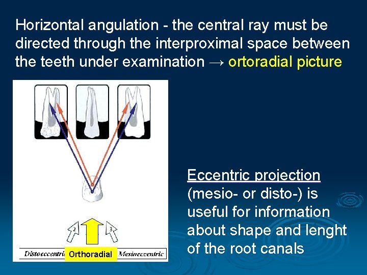 Horizontal angulation - the central ray must be directed through the interproximal space between