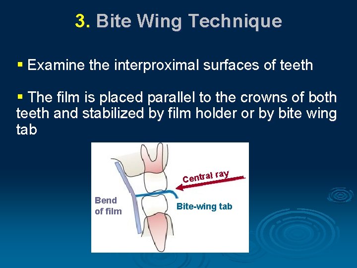 3. Bite Wing Technique § Examine the interproximal surfaces of teeth § The film