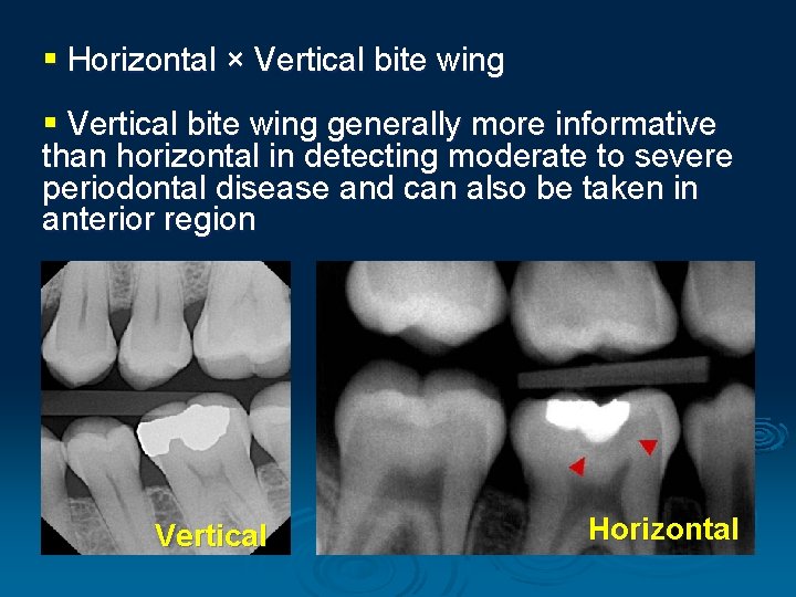 § Horizontal × Vertical bite wing § Vertical bite wing generally more informative than