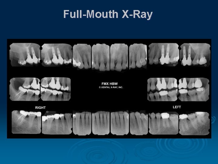 Full-Mouth X-Ray 