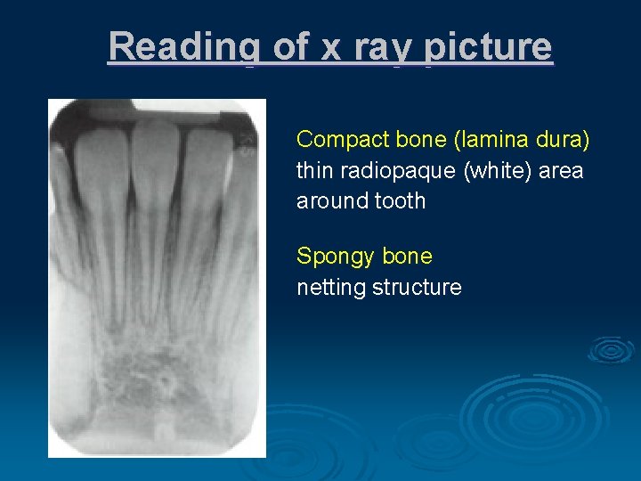 Reading of x ray picture Compact bone (lamina dura) thin radiopaque (white) area around