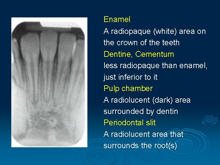 Enamel A radiopaque (white) area on the crown of the teeth Dentine, Cementum less