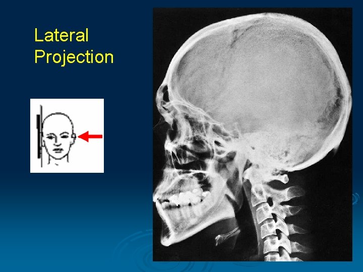 Lateral Projection 