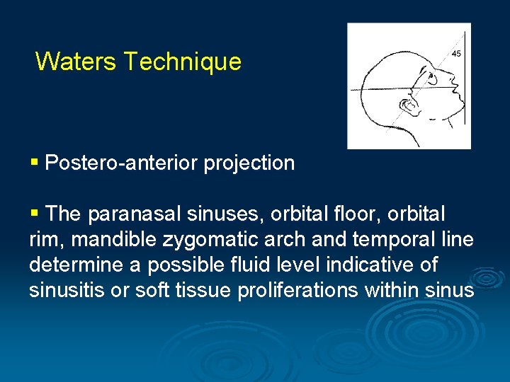 Waters Technique § Postero-anterior projection § The paranasal sinuses, orbital floor, orbital rim, mandible Waters Technique § Postero-anterior projection § The paranasal sinuses, orbital floor, orbital rim, mandible