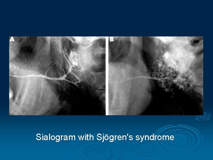 Sialogram with Sjögren's syndrome 