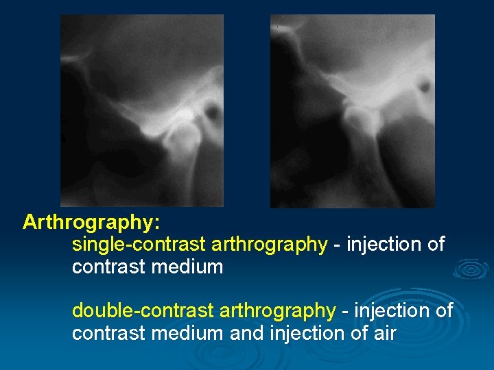 Arthrography: single-contrast arthrography - injection of contrast medium double-contrast arthrography - injection of contrast