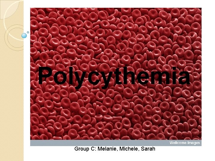 Polycythemia Group C: Melanie, Michele, Sarah 