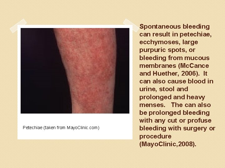 Petechiae (taken from Mayo. Clinic. com) Spontaneous bleeding can result in petechiae, ecchymoses, large