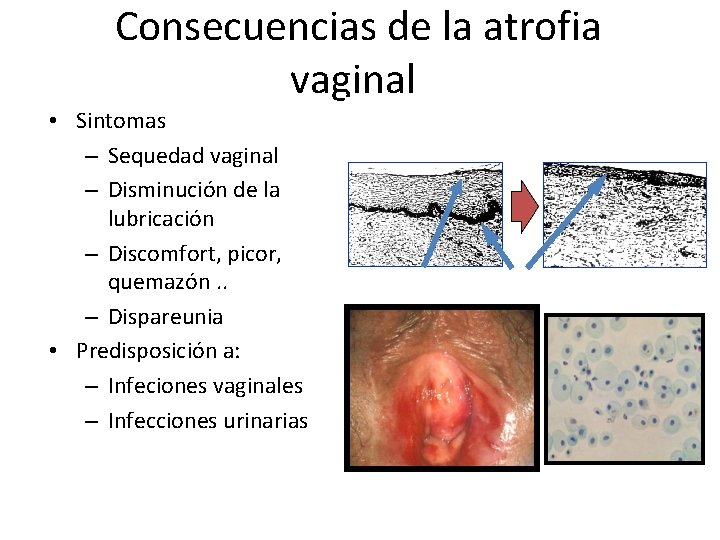 Consecuencias de la atrofia vaginal • Sintomas – Sequedad vaginal – Disminución de la