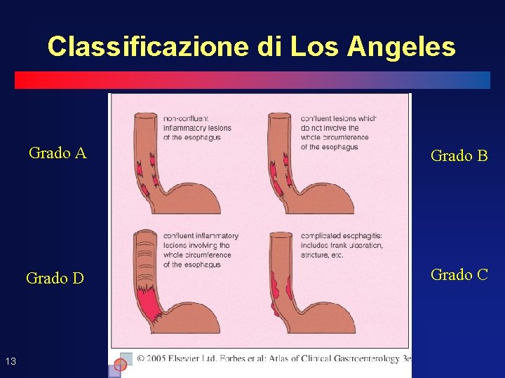 Classificazione di Los Angeles 13 Grado A Grado B Grado D Grado C 