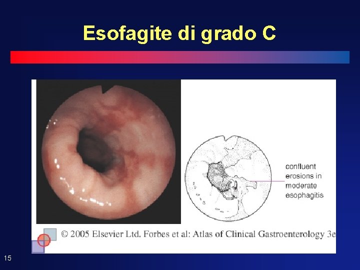 Esofagite di grado C 15 