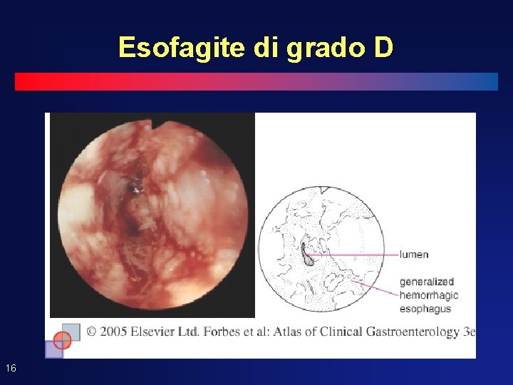 Esofagite di grado D 16 