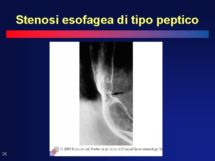 Stenosi esofagea di tipo peptico 26 