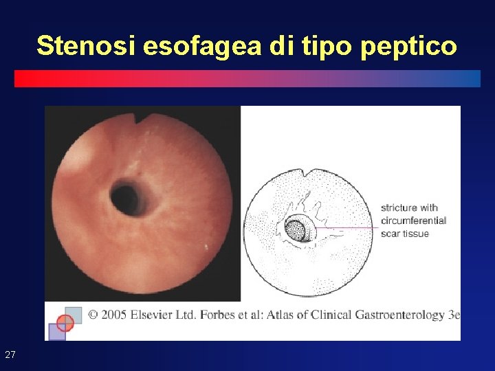 Stenosi esofagea di tipo peptico 27 