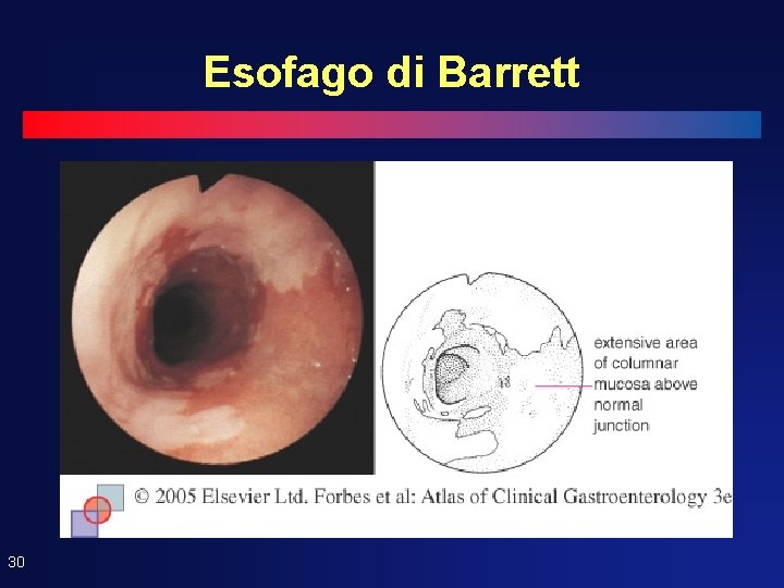 Esofago di Barrett 30 