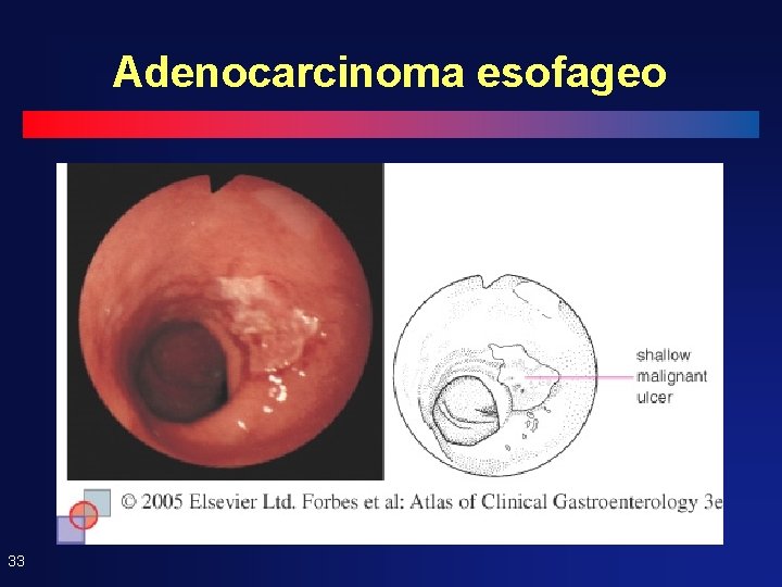 Adenocarcinoma esofageo 33 