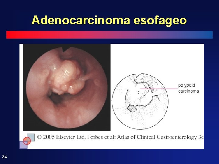 Adenocarcinoma esofageo 34 