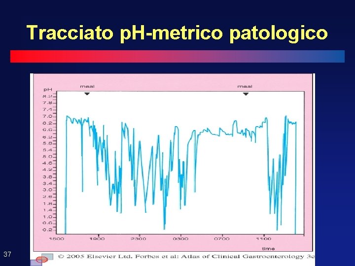 Tracciato p. H-metrico patologico 37 