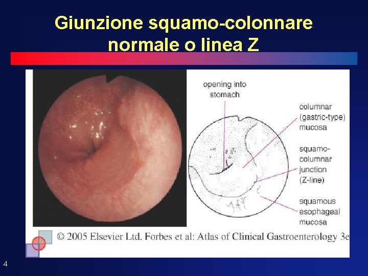 Giunzione squamo-colonnare normale o linea Z 4 