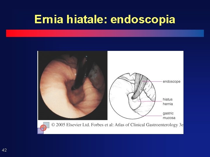 Ernia hiatale: endoscopia 42 