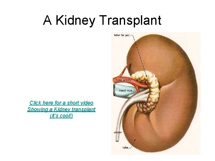 A Kidney Transplant Click here for a short video Showing a Kidney transplant (it’s