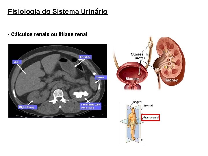 Fisiologia do Sistema Urinário • Cálculos renais ou litíase renal 