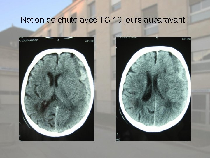 Notion de chute avec TC 10 jours auparavant ! 