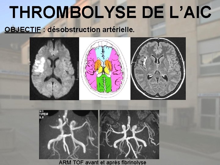 THROMBOLYSE DE L’AIC OBJECTIF : désobstruction artérielle. ARM TOF avant et après fibrinolyse 