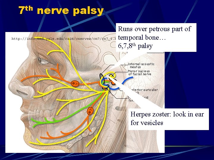 7 th nerve palsy Runs over petrous part of temporal bone… 6, 7, 8