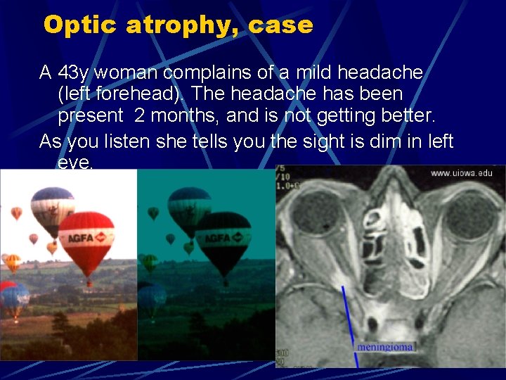 Optic atrophy, case A 43 y woman complains of a mild headache (left forehead).