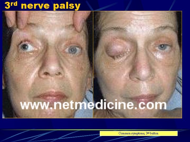 3 rd nerve palsy Common symptoms, 3 rd button 