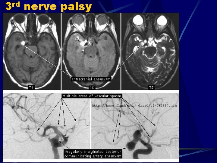 3 rd nerve palsy 