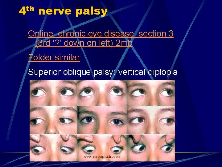 4 th nerve palsy Online, chronic eye disease, section 3 (3 rd ‘? ’