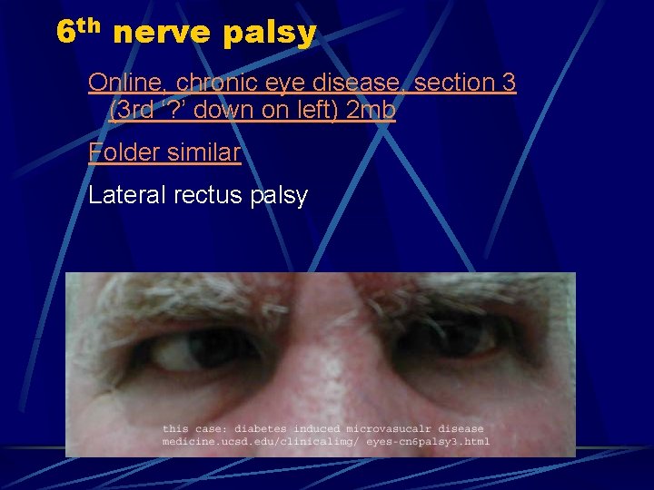 6 th nerve palsy Online, chronic eye disease, section 3 (3 rd ‘? ’