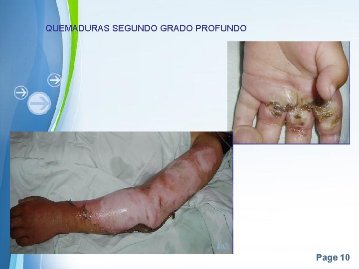 QUEMADURAS SEGUNDO GRADO PROFUNDO Page 10 QUEMADURAS SEGUNDO GRADO PROFUNDO Page 10