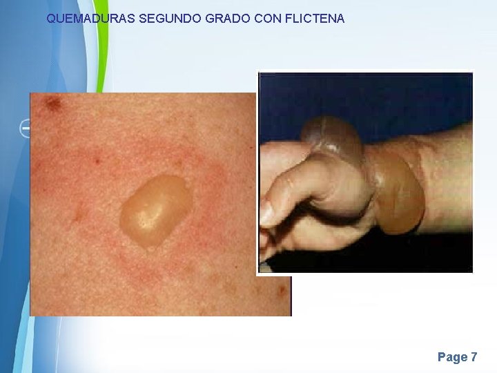 QUEMADURAS SEGUNDO GRADO CON FLICTENA Page 7 QUEMADURAS SEGUNDO GRADO CON FLICTENA Page 7