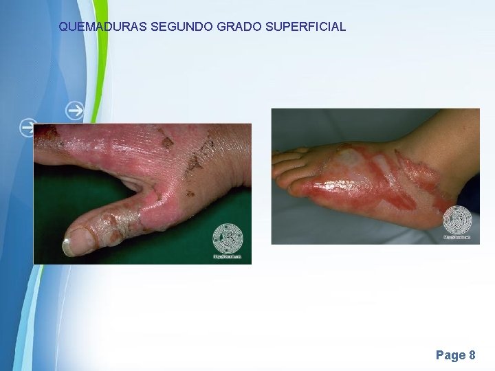 QUEMADURAS SEGUNDO GRADO SUPERFICIAL Page 8 QUEMADURAS SEGUNDO GRADO SUPERFICIAL Page 8