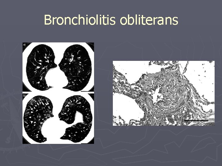 Bronchiolitis obliterans 