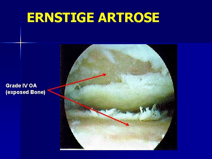 ERNSTIGE ARTROSE Grade IV OA (exposed Bone) 