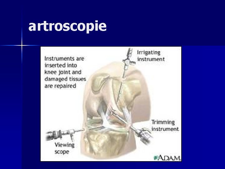 artroscopie 