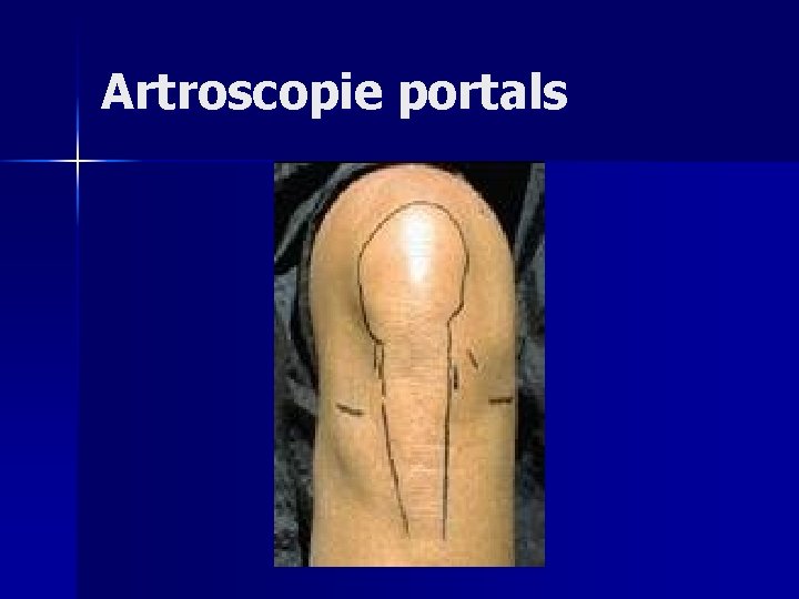 Artroscopie portals 